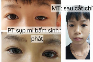 Điều trị sụp mi bẩm sinh tại Bệnh viện Đa khoa tỉnh Bắc Giang