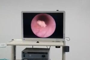 Bệnh viện Đa khoa tỉnh Bắc Giang: Tán sỏi niệu quản nội soi ngược dòng bằng laser cho bệnh nhân có thận duy nhất