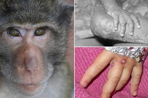 Bộ Y tế ban hành hướng dẫn chẩn đoán, điều trị và phòng bệnh đậu mùa khỉ ở người