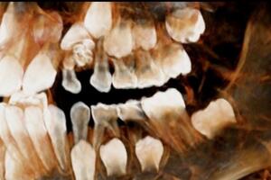 U răng – 1 trong những nguyên nhân “ gây ra “ thiếu răng trên cung hàm