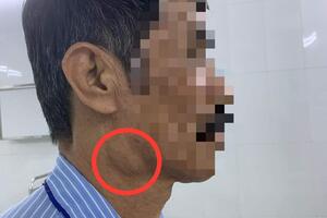 Phẫu thuật cắt u tuyến nước bọt mang tai tại Bệnh viện Đa khoa tỉnh Bắc Giang
